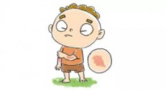 过敏治疗